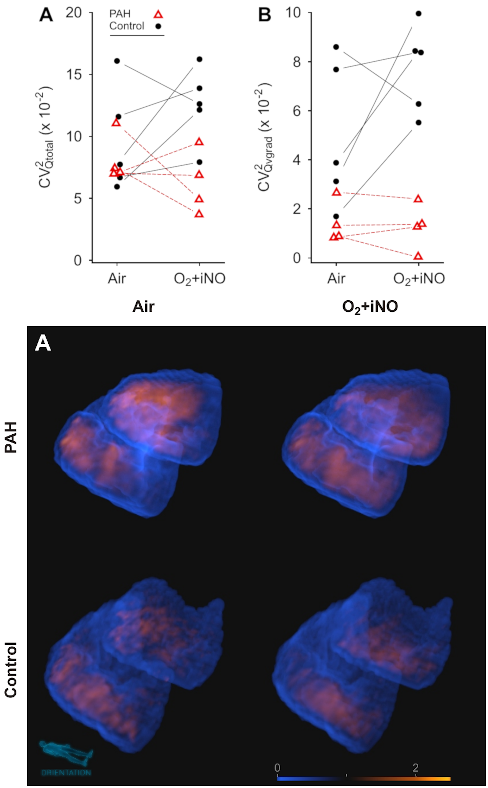 summary image: figure excerpt showing the discrimination between PAH and controls, and panel with 3D renderings of pulmonary perfusion