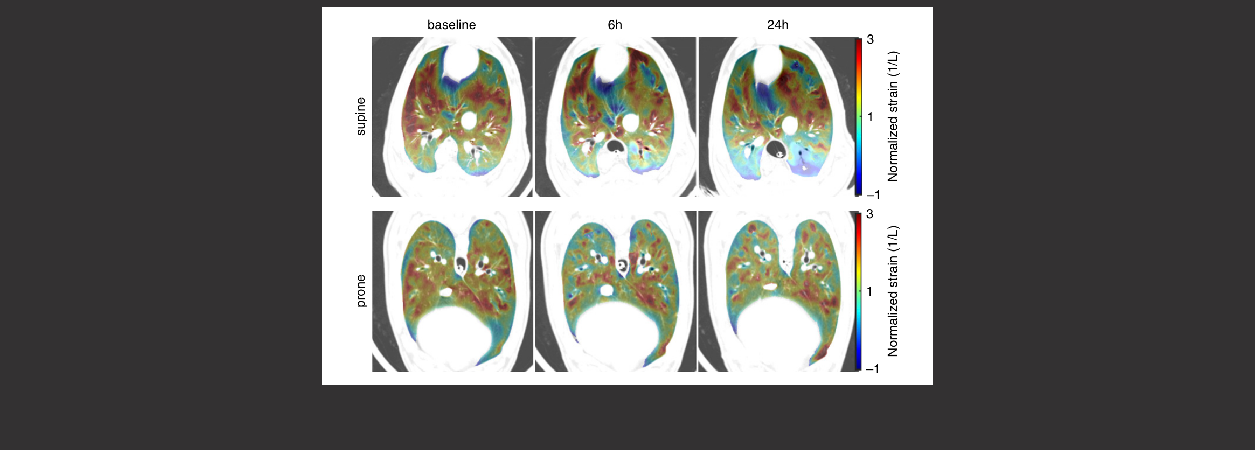 Imaging of strain in the lungs